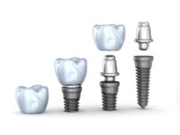 Korona na implancie z łącznikiem (cyrkonowa)