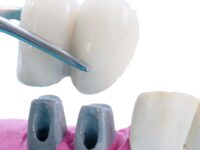 Korona porcelanowa na metalu