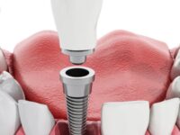Wszczepienie implantu