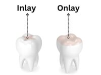 Onlay / inlay kompozytowy